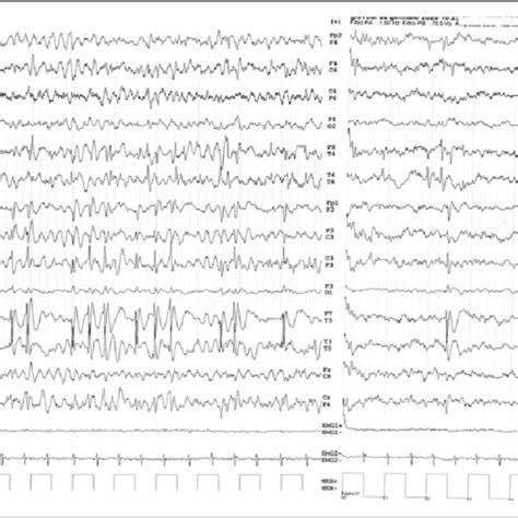 Interictal Eeg With Multifocal Epileptiform Discharges Activated By