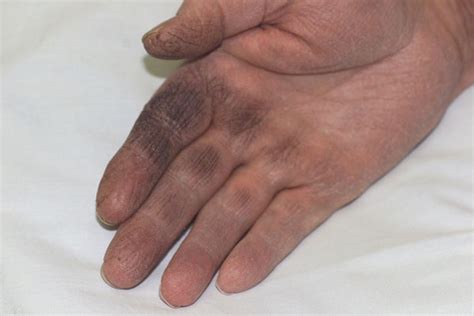 Derm Dx Black Discoloration Of The Hands Clinical Advisor