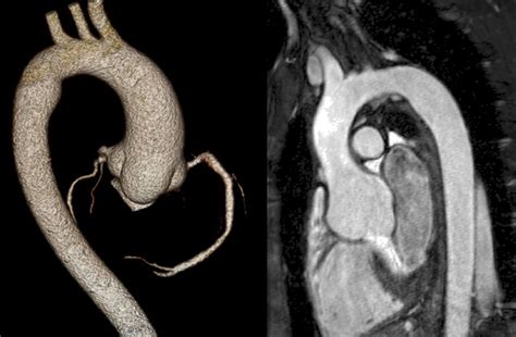 Surgical Management Of Aortic Root Disease In Marfan Syndrome And Other