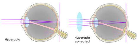 Flexi Answers How Can A Convex Lens Be Used To Correct Hyperopia