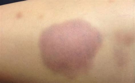 Random Bruising Meaning Causes Of Thighs Body Legs Back Breast
