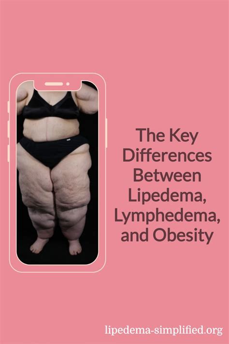 About Lymphedema And Lipedema Obesityhelp My Xxx Hot Girl