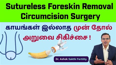 Sutureless Foreskin Removal Circumcision Surgery காயங்கள் இல்லாத முன்