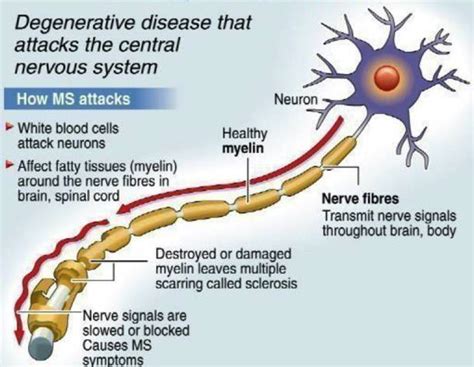 Some people's symptoms develop and worsen steadily over time, while for others they come and go. Multiple Sclerosis and Exercise - Pivotal Physio