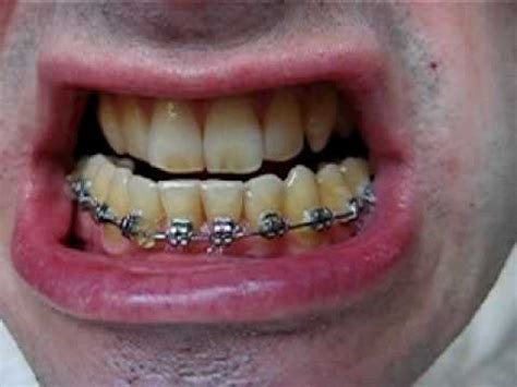 Ice will work in your mouth just like it does for other injured parts of the body. metal bottom braces rubber part 5 weeks - YouTube