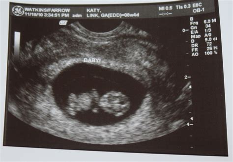 8 Weeks 4 Days Pregnant Ultrasound Images