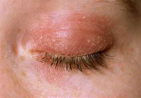 Eczema On Eyelid Symptoms Causes Pictures Treatment