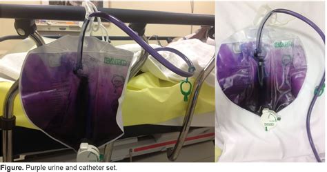 While purple urine bag syndrome is rare (the exact incidence in unknown), urine in colors beyond the usual yellow is much less so. Purple Urine Bag Syndrome - The Western Journal of ...