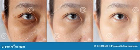 Three Pictures Compared Effect Before And After Treatment Under Eyes