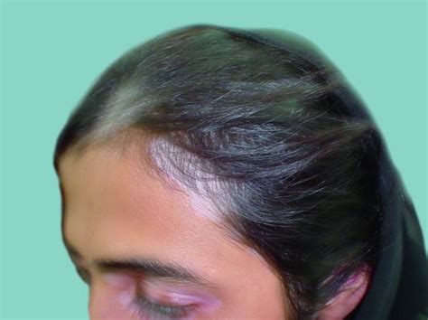 Image Vitiligo With Hair Depigmentation Merck Manuals Consumer Version