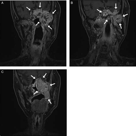 Nasopharyngeal Radiation Induced Sarcoma A Case Report Wei Hsiang Su