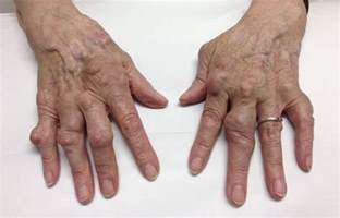 Rheumatoid Arthritis Rheumexam Atlas