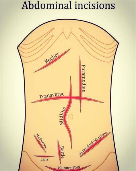 Abdominal Incisions In General Surger Medical Surgical Nursing