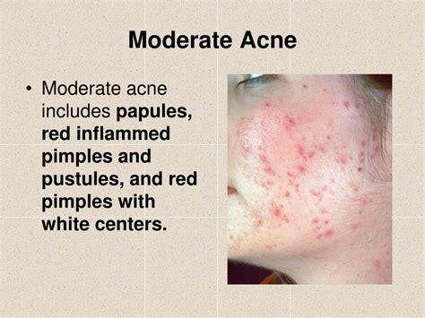 Ppt Acne And Other Skin Conditions Powerpoint Presentation Free