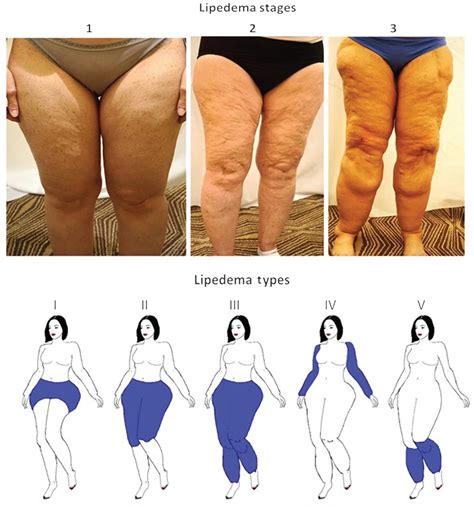Understanding The Differences Between Lymphedema And Lipedema A My
