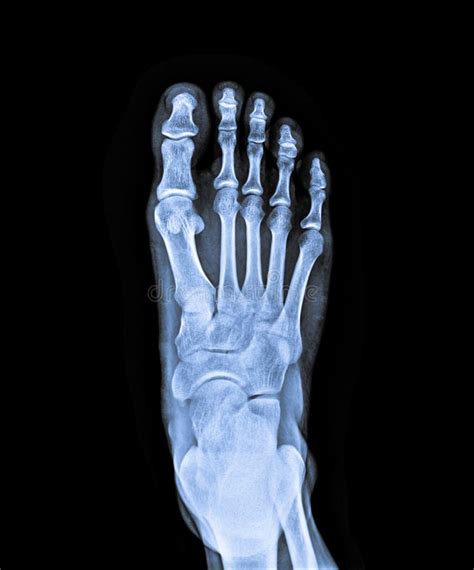 X Ray Of Right Foot Stock Photo Image Of Care Anatomy 74641660
