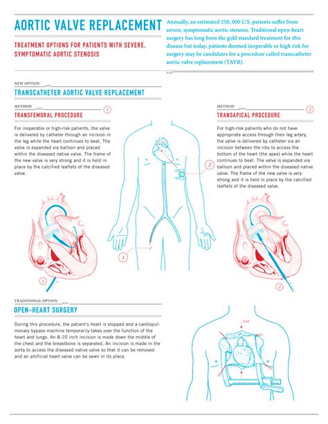 Valve Replacement Risks Of Aortic Valve Replacement Surgery