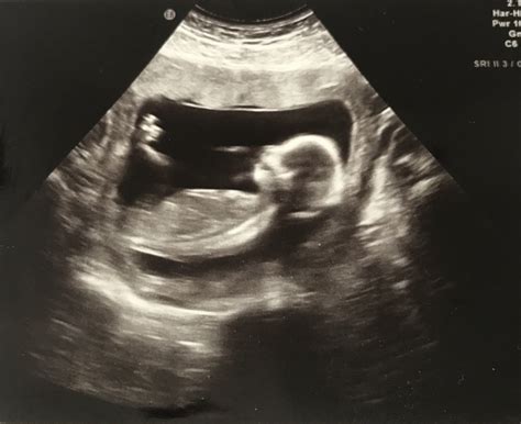 Mit hilfe des vaginalen ultraschalls lässt sich auch eine schwangerschaft feststellen. 43 Top Photos Schwanger Wann Ultraschall / 5 6 Was Muss ...