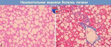 Жировое изменение печени диета Жировое перерождение печени как лечить Жировое перерождение печени как лечить Жировое изменение печени диета