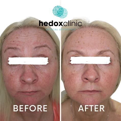 Advanced Botox London Anti Wrinkle Treatment Hedox Clinic