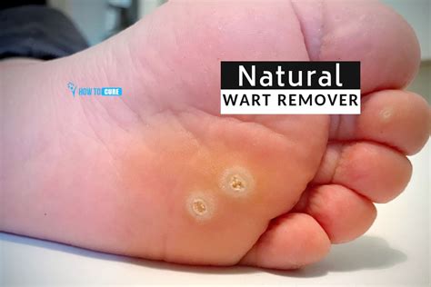 Natural Wart Remover 5 Incredible Home Treatments How To Cure