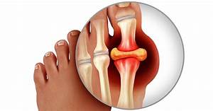 Gout (Gouty Arthritis) Risk Factors, Diagnosis and Treatment Gout  