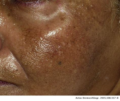 Patchy Facial Hyperpigmentation Actas Dermo Sifiliográficas English