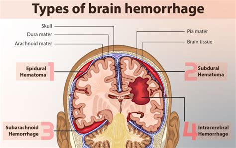Difference Between Intracranial Hemorrhage And Cerebral Hemorrhage