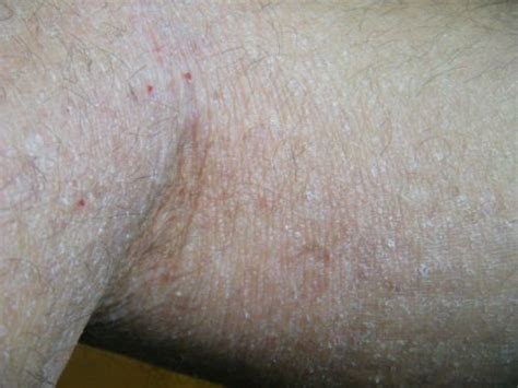 Dry Skin Eczema Pictures Dorothee Padraig South West Skin Health Care