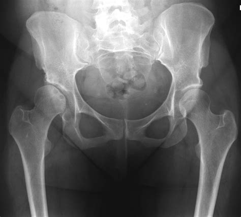 (2a) right hip avn was diagnosed one year prior in this patient, and stigmata of core decompression are seen at the right femoral head (arrowheads) on the femoral head is the most common location for avascular necrosis (avn). Avascular necrosis of the femoral head | Image ...