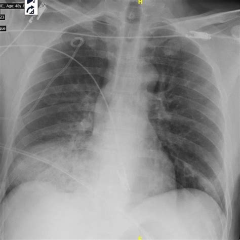 Radiograph Of Chest Showing A Complete Right Pneumothorax Download Scientific Diagram