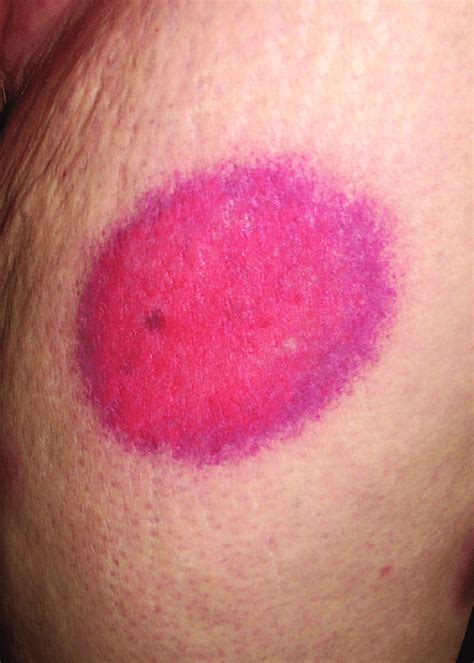 Purpuric Fixed Drug Eruption On The Left Upper Thigh Download