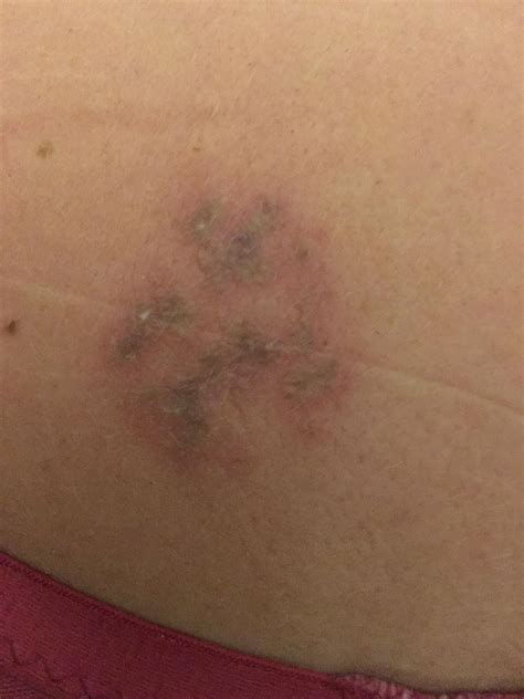 Shingles Super Itchy Blister Rash Now Turned Into This See Comments