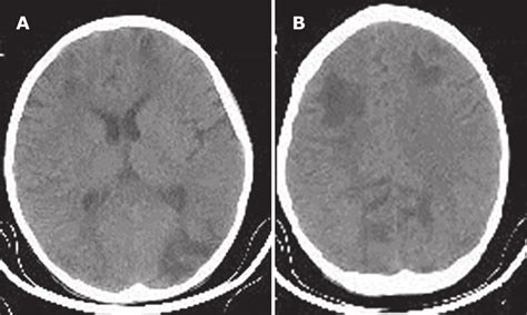 The Axial Non Contrast Brain Ct Scan Demonstrating Hypodensity