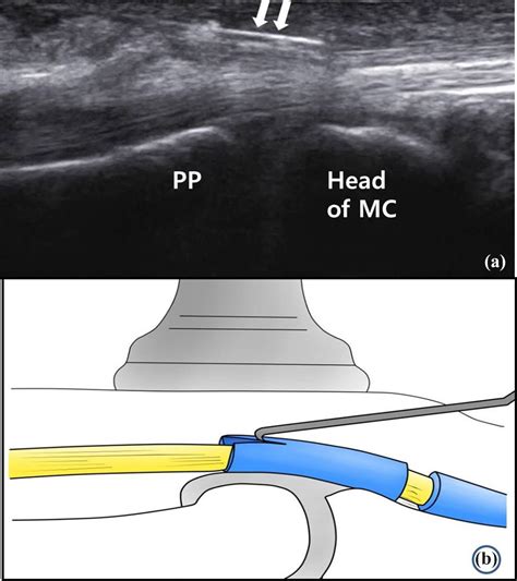 Comparative Study Of Ultrasonography Guided Percutaneous A1 Pulley