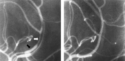 Primary Angiitis Of The Central Nervous System Differential Diagnosis