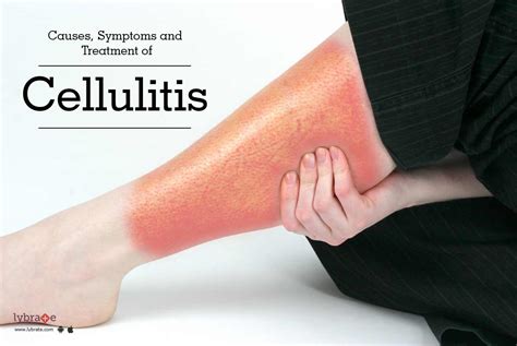 Cellulitis Causes Signs Symptoms And Treatment By Dr Sandeep