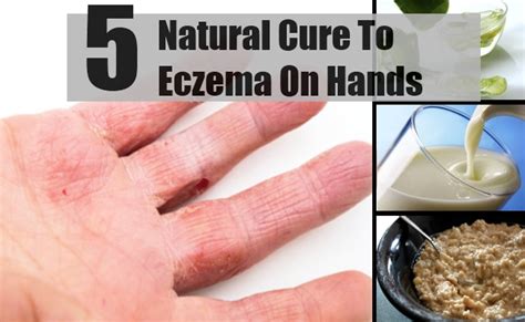Pdf eczema natural cures proven selfcare guide diet that really work top rated 30min pdf online. 5 Natural Cure For Eczema On Hands - How To Cure Eczema On ...