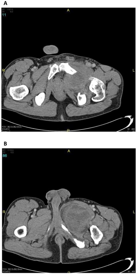 Pre Operative Ct Scan A Malignant Peripheral Nerve Sheath Tumor With
