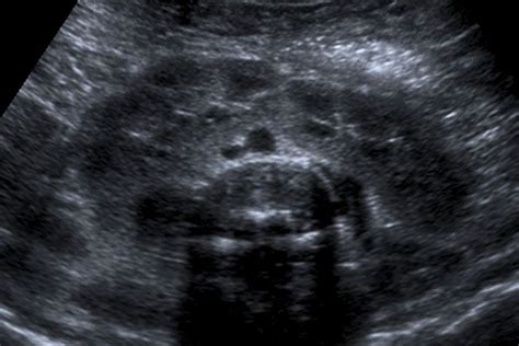 Horseshoe Kidney As Seen On Ultrasound Normal Variant Radiology