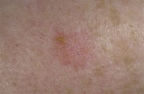 Early Signs Of Skin Cancer Pictures 15 Photos Images Illnessee Com
