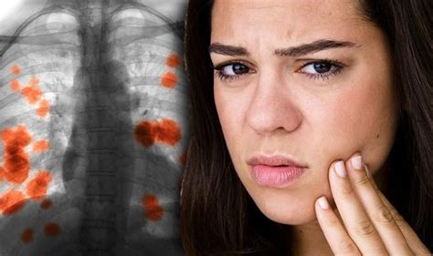 Lung Cancer Symptoms Signs Of A Tumour Include Swollen Face And Neck