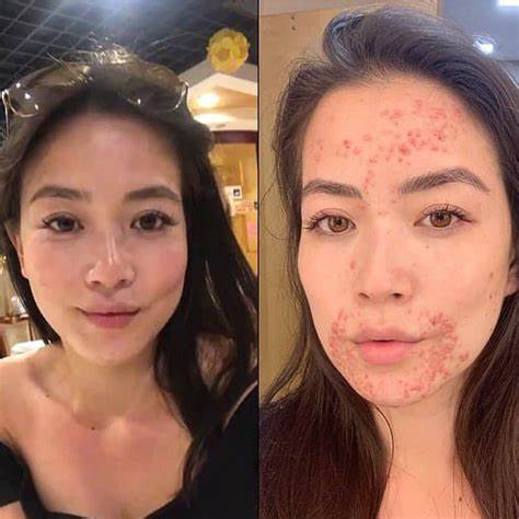 Дерматит симптомы диета Стероидный дерматит: 8 фото, причины, симптомы, лечение, профилактика Стероидный дерматит: 8 фото, причины, симптомы, лечение, профилактика Дерматит симптомы диета