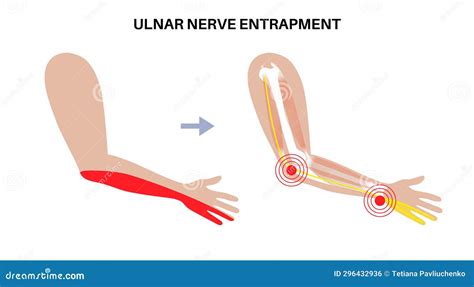 Ulnar Nerve Entrapment Vector Illustration 296965506