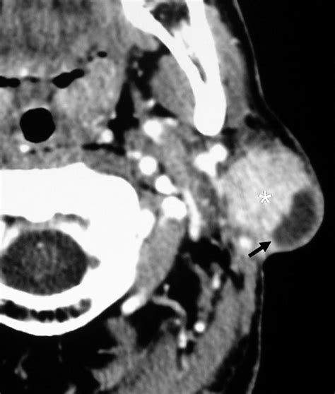 Ct Features Of Parotid Gland Oncocytomas A Study Of 10 Cases And