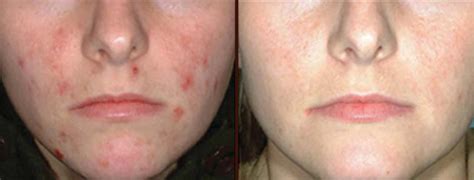 Ipl Rosacea And Acne Treatment Cosmetic Surgery In