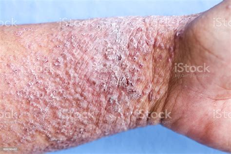 Foto De Dermatite Atópica E Mais Fotos De Stock De Eczema Atópico Istock