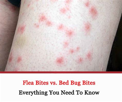 Flea Vs Bed Bug Bites Identification Other Bites And 75C