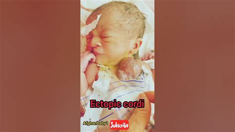 Ectopia Cordis Is A Rare Congenital Condition In Which Some Or All Of A