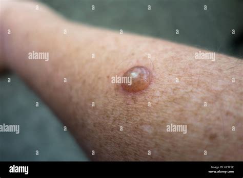Dermatology Problems Hi Res Stock Photography And Images Alamy